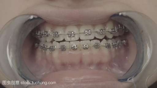 假牙的牙冠与真牙的区别6,牙冠和真牙一样吗(图1)